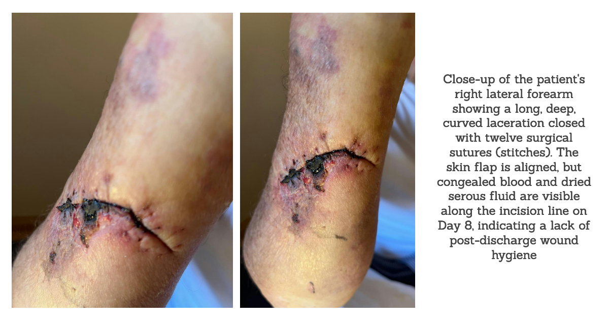 Close-up of the patient's right lateral forearm showing a long, deep, curved laceration closed with twelve surgical sutures (stitches) . The skin flap is aligned, but congealed blood and dried serous fluid are visible along the incision line on Day 8, indicating a lack of post-discharge wound hygiene